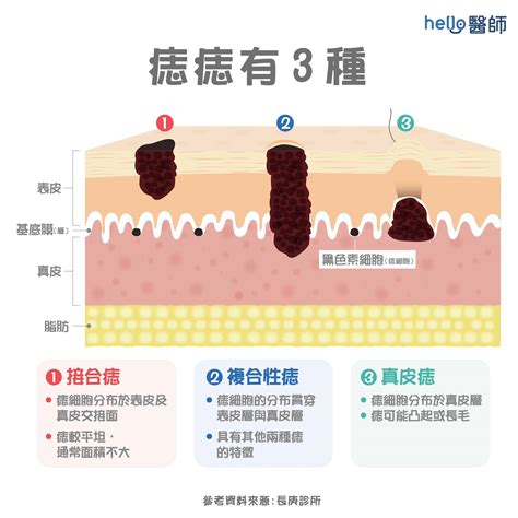 蒼蠅痣|痣形成的原因？痣長毛、痣變多變大是痣病變？5招判別